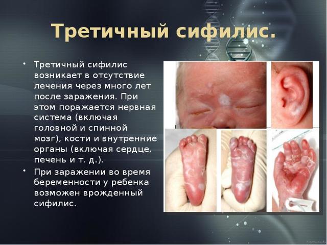 Сифилис у женщин – первые признаки, симптомы, лечение