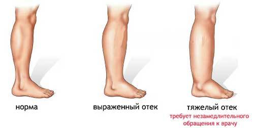 Отеки при сердечной недостаточности - патогенез, симптомы и лечение
