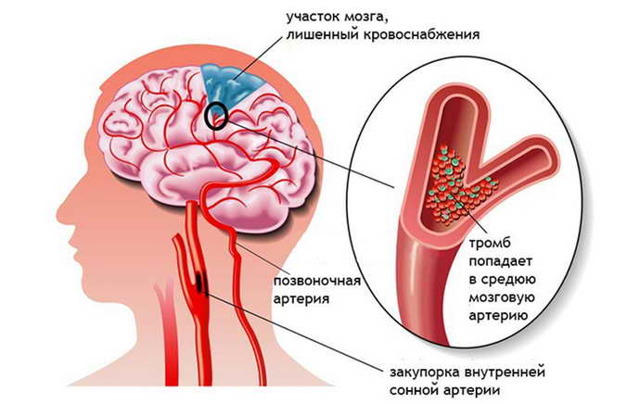 Сколько живут после инсульта - как жить после инсульта?
