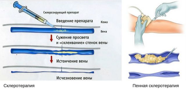 Склеротерапия вен нижних конечностей: плюсы и минусы