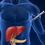 Избыток инсулина в крови: симптомы, что делать