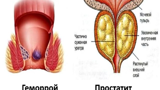 Как геморрой влияет на простату - Простатит