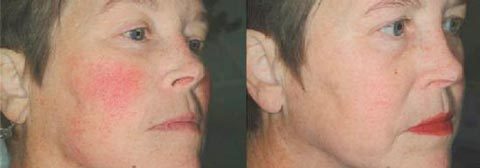 Как убрать красные сосуды на лице в домашних условиях