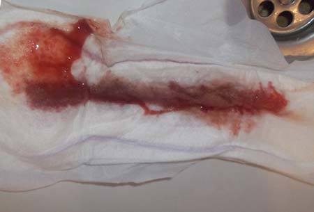 Имплантационное кровотечение - Лечение кровотечений