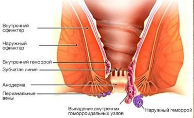 Лечение геморроя в домашних условиях быстро картофелем