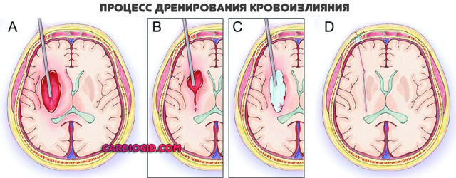 Ишемический инсульт: лечение и профилактика медикаментами