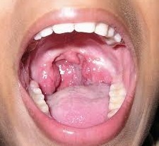 Паратонзиллярный абсцесс: лечение, фото, симптомы