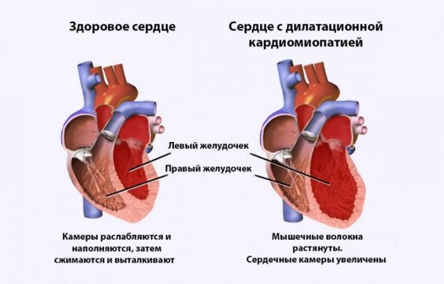Кардиомиопатия: что это такое, виды, симптомы и лечение