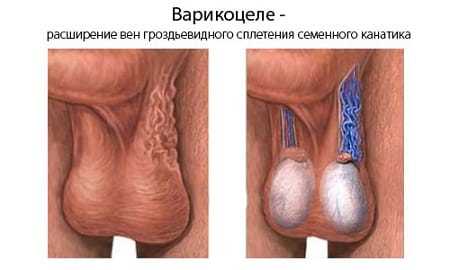 Варикоз на яичках: основные проявления