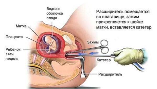 Чистка матки: показания к проведению операции и её последствия