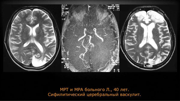 Васкулит мозга