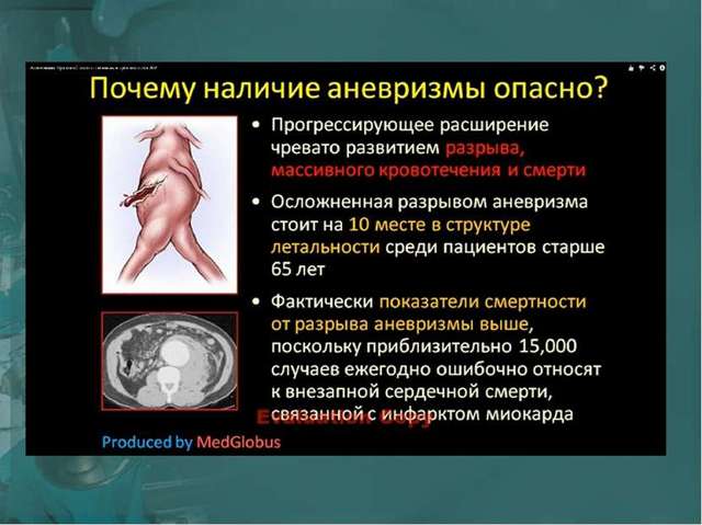 Лечение аневризмы брюшной аорты, операция аневризмы брюшной полости: цена в СПб.