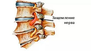 Покалывание в верхней части грудной клетки