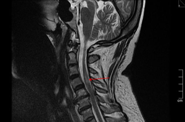 Инсульт спинного мозга (спинальный): симптомы, лечение, последствия
