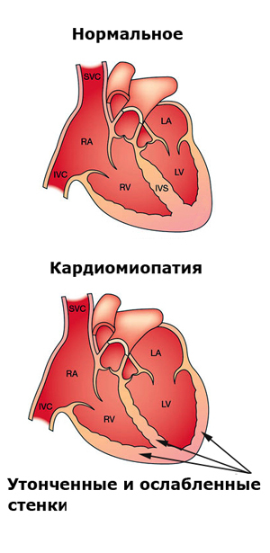 Алкогольная кардиомиопатия причина смерти — ВредКурения