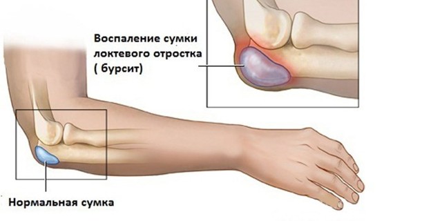 Боль в локтевом суставе: причины, лечение и профилактика