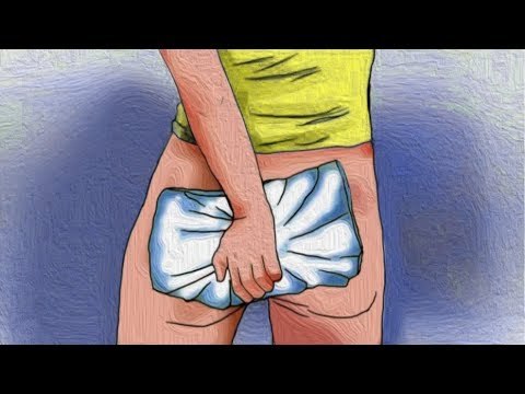 Внутренний геморрой лечение в домашних условиях