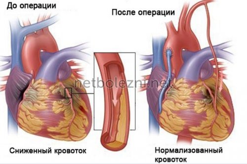 Стентирование коронарных артерий: операция, послеоперационный период, реабилитация