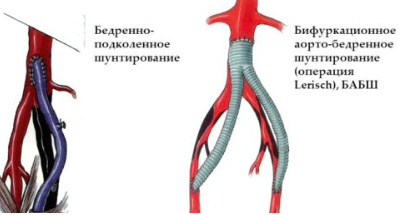 Операция по чистке сосудов нижних конечностей