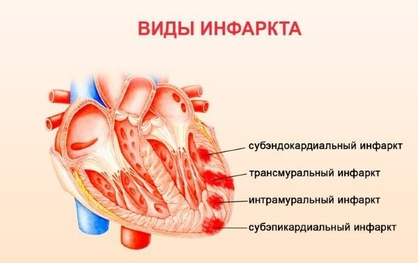 Лфк при инфаркте миокарда упражнения