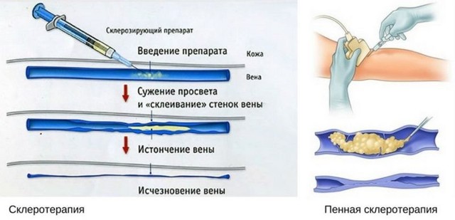 Уколы от варикоза вен на ногах