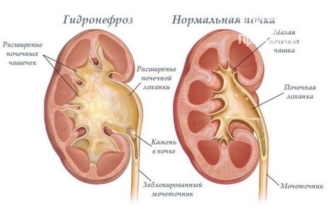 Мочекаменная болезнь симптомы и лечение у мужчин