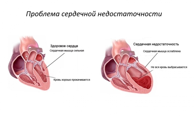 Что такое легочная гипертензия, её симптомы и лечение