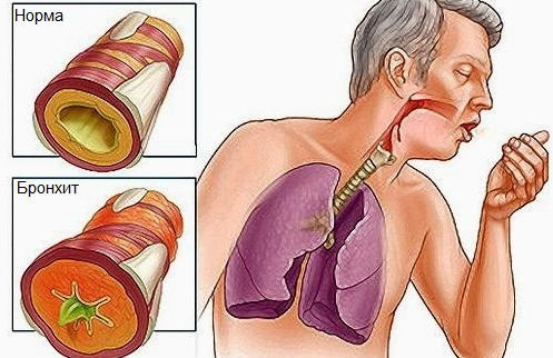 Покалывание в верхней части грудной клетки
