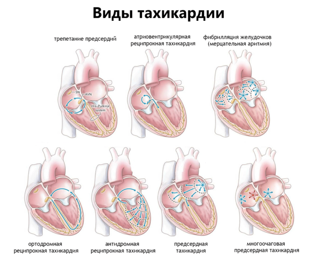 Какие лекарства пить при тахикардии