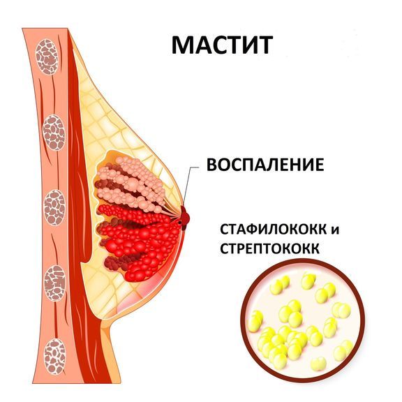 Болит грудь сбоку: причины и симптомы