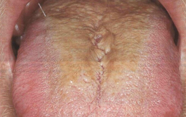 Коричневый налет на языке