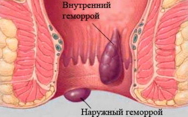Лечение трещины заднего прохода без операции