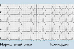Можно ли заниматься спортом при тахикардии: польза