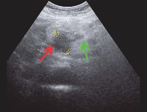 Билиарная гипертензия печени: симптомы, признаки на УЗИ и лечение синдрома