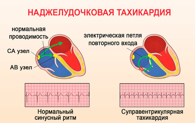 Берут ли в армию с тахикардией в 2019 году?