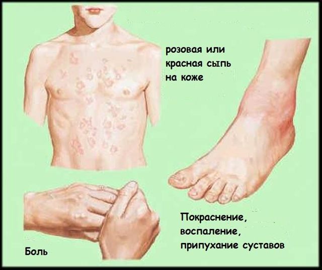 Ревматизм - причины, признаки, симптомы и лечение