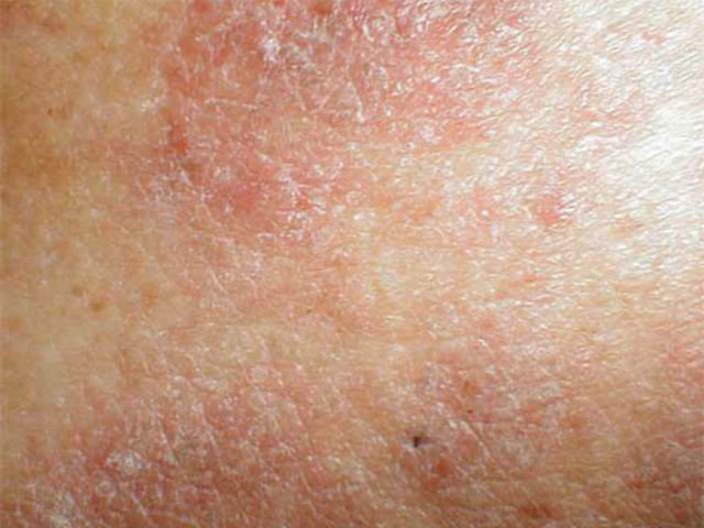 Нейродермит у взрослых и детей: симптомы (фото), лечение