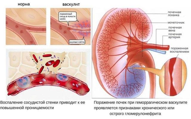 Васкулит – что это за болезнь? Причины, виды и формы васкулита (геморрагический, аллергический, системный, кожный и др.), симптомы и диагностика заболевания, фото