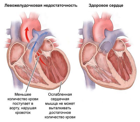 Левожелудочковая недостаточность: симптомы, лечение