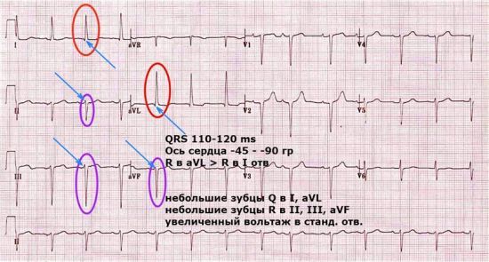 ЭКГ при блокаде правой ножки пучка Гиса (ПНПГ)