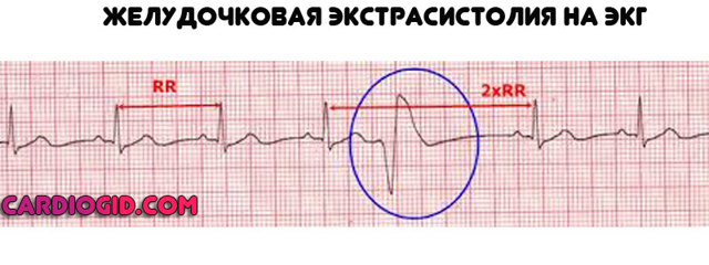 Дополнительная хорда в сердце у ребенка - что это такое и чем опасна?