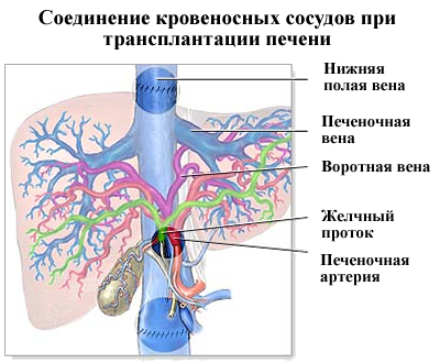 Пересадка печени: виды, выбор донора, ход процедуры.