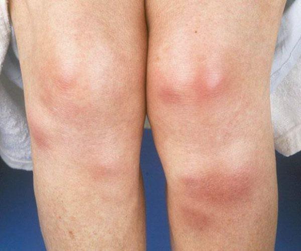 Васкулит на ногах - что это такое и как лечить?