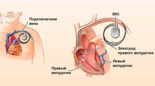 Кардиостимулятор сердца: показания к операции