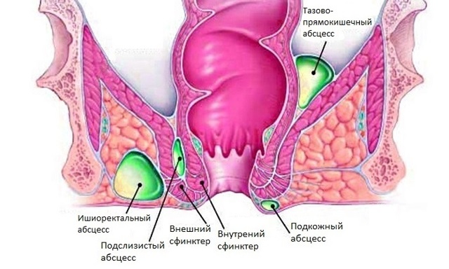 Лечение геморроя 1, 2, 3 и 4 стадии - современные операции