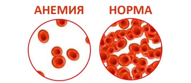 Анемия у грудного ребенка: признаки, симптомы и лечение