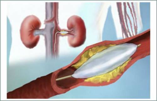 Реноваскулярная гипертензия - лечение, причины