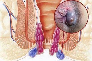 Геморрой при беременности - признаки, симптомы, причины и лечение