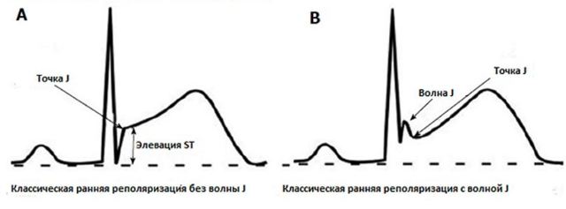 Синдром ранней реполяризации желудочков сердца – что это, чем опасен ЭКГ-феномен? Признаки синдрома ранней реполяризации желудочков