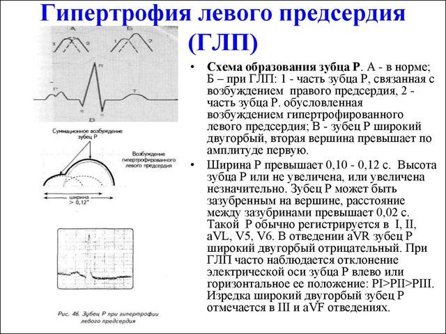 Гипертрофия левого предсердия что это такое - Всё о сердце